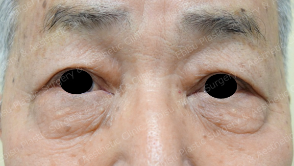 下眼瞼除皺術（ Hamra 法） 施症例写真