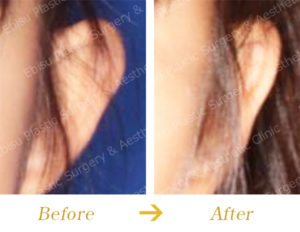 たち耳の外科的治療のビフォーアフター画像