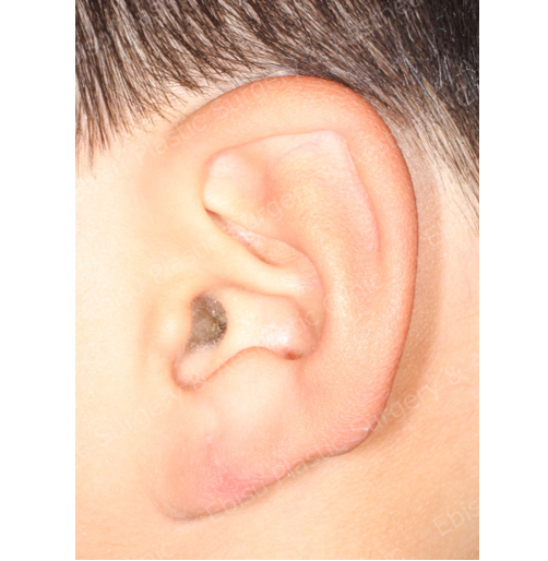 耳垂形成術症例写真