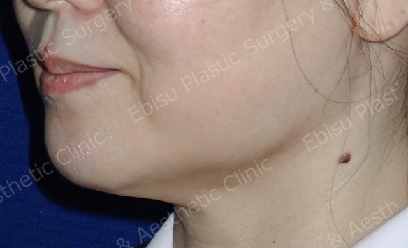 あご下の脂肪溶解注射（メソラインスリム<sup>®</sup>）症例写真