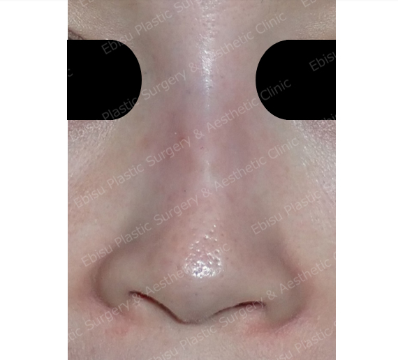 鼻のヒアルロン酸注入症例写真