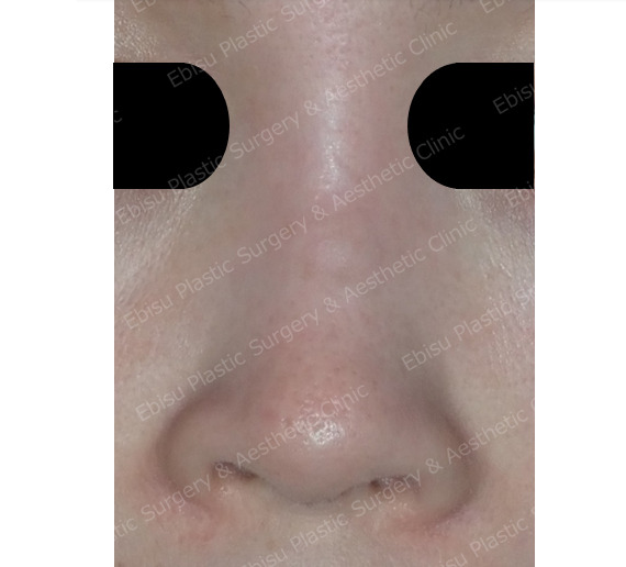 鼻のヒアルロン酸注入症例写真