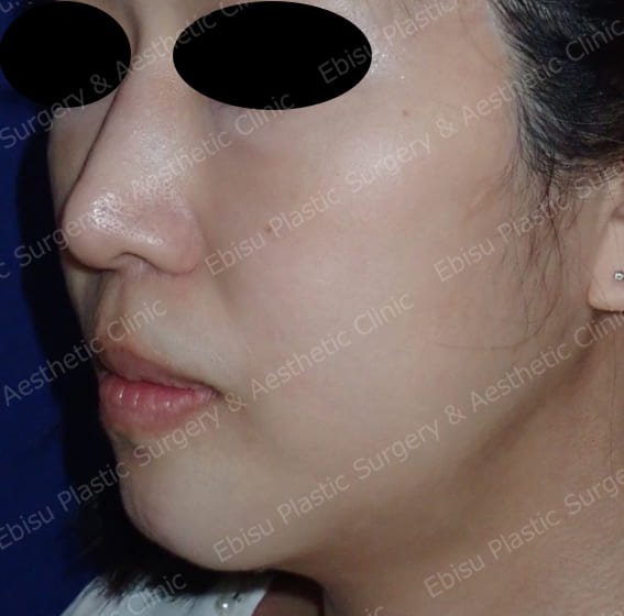 顎プロテーゼによる骨格形成術症例写真