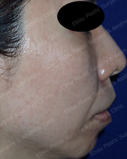 ヒアルロン酸による法令線治療と頬部のリフトアップ症例写真