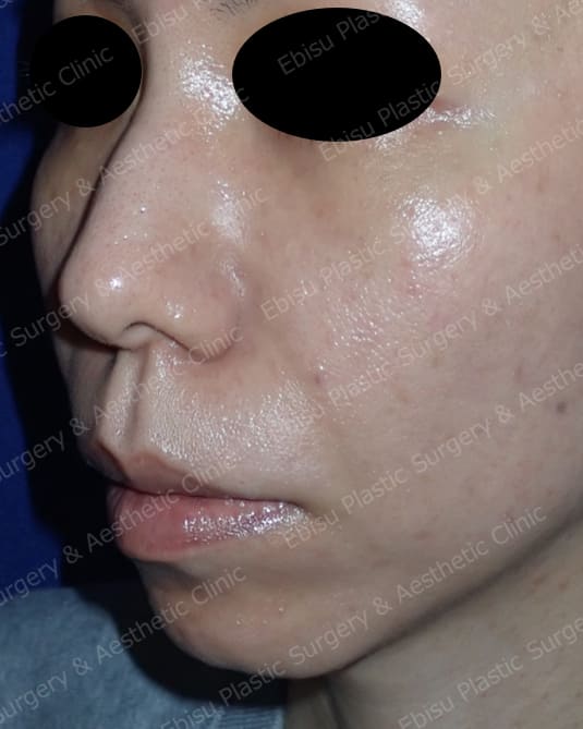 ヒアルロン酸による法令線治療と頬部のリフトアップ症例写真