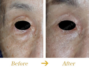下眼瞼除皺術（Hamra法)+脂肪注入術によるクマ・たるみ治療のビフォーアフター画像