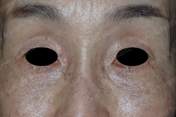 下眼瞼除皺術（Hamra法）+　脂肪注入術症例写真