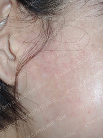 扁平母斑症に対するPICO レーザー症例写真