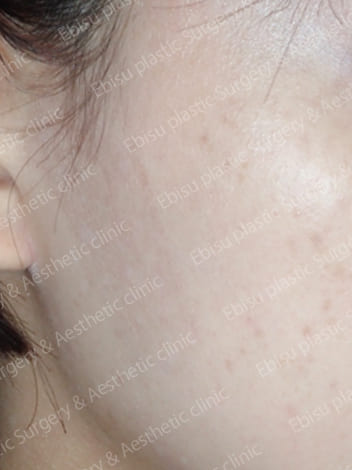 扁平母斑症に対するPICO レーザー症例写真