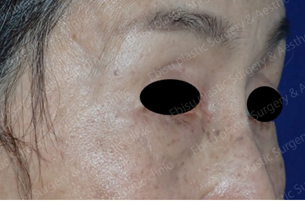 下眼瞼除皺術（Hamra法）+　脂肪注入術症例写真